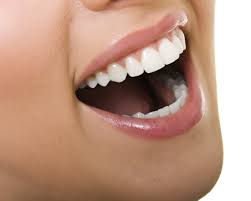 carillas dentales